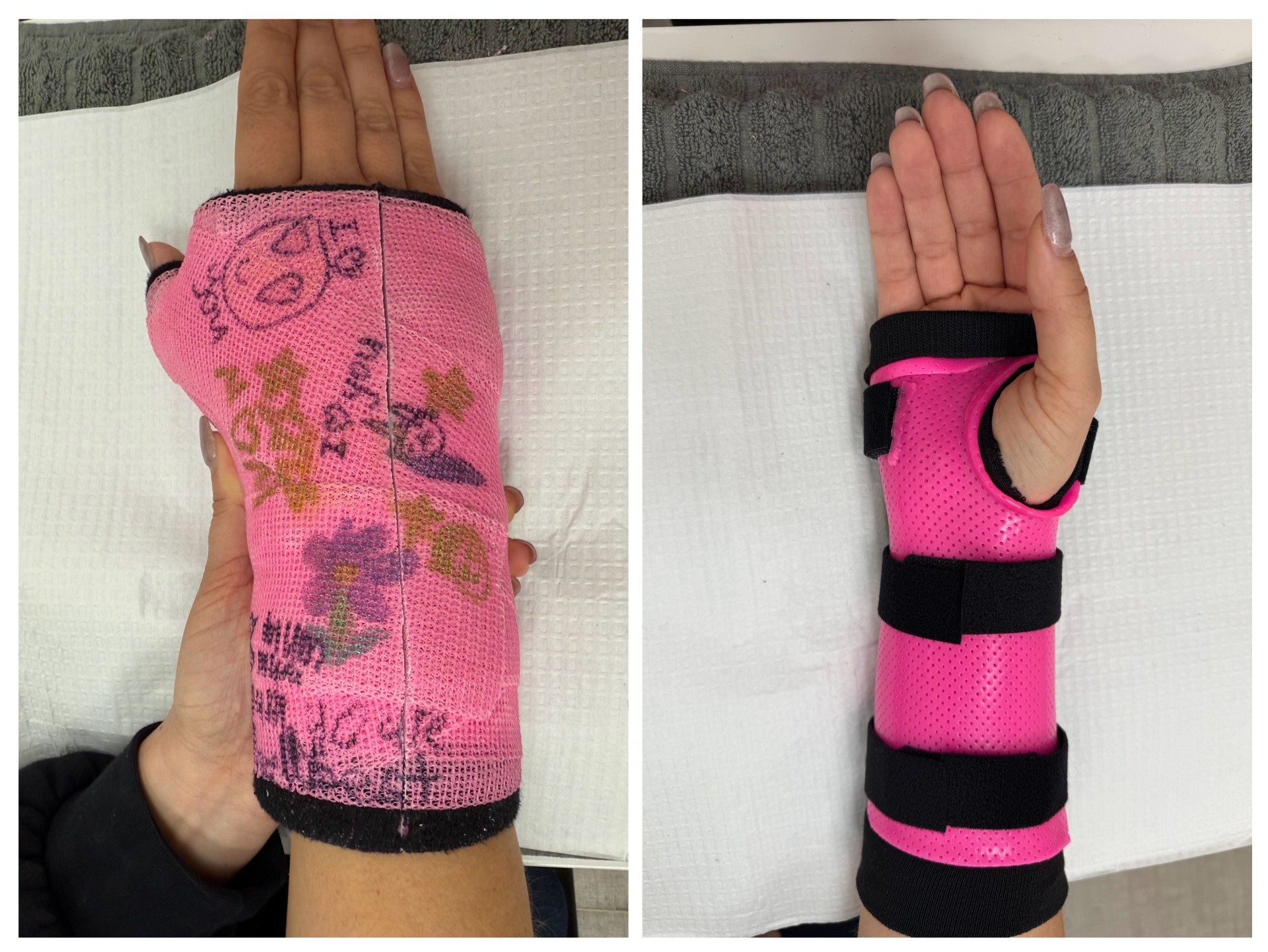 Shows a custom pink thermoplastic Splint and cast for hand and wrist with drawings for the patient.