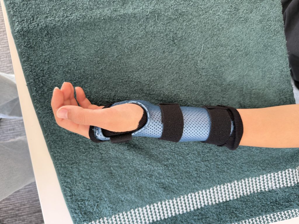 Shows a custom thermoplastic Splint and cast for hand and wrist.